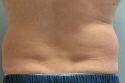 Coolsculpting Before & After Patient #296