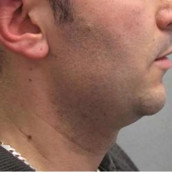 Ultherapy Before & After Patient #303