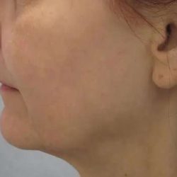 Ultherapy Before & After Patient #306