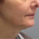 Ultherapy Before & After Patient #309