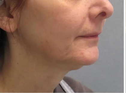 Ultherapy Before & After Patient #309