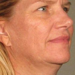 Ultherapy Before & After Patient #312