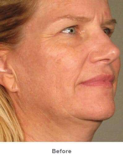 Ultherapy Before & After Patient #312