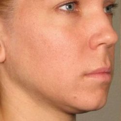 Ultherapy Before & After Patient #315