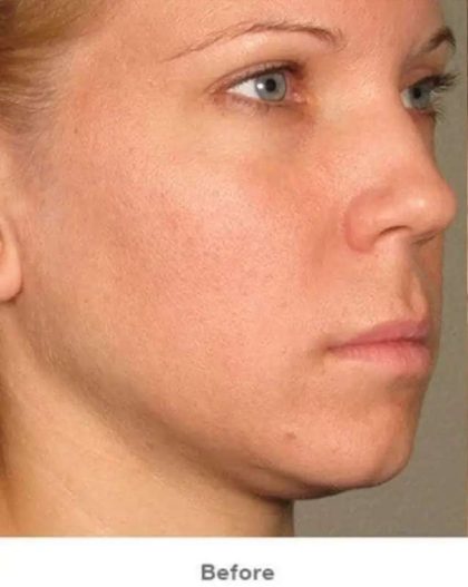 Ultherapy Before & After Patient #315