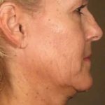 Ultherapy Before & After Patient #318