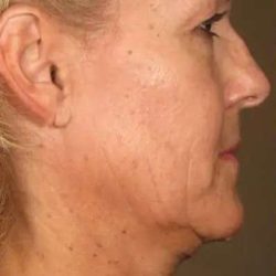 Ultherapy Before & After Patient #318