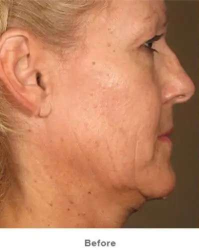 Ultherapy Before & After Patient #318