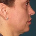 Ultherapy Before & After Patient #321