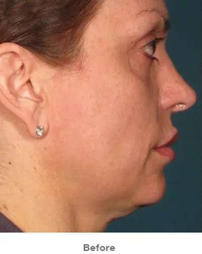 Ultherapy Before & After Patient #321