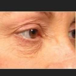 Ultherapy Before & After Patient #324