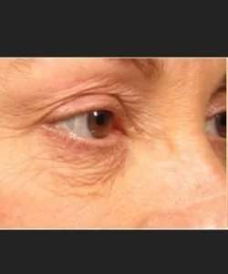 Ultherapy Before & After Patient #324