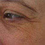 Ultherapy Before & After Patient #327
