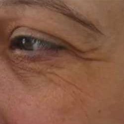 Ultherapy Before & After Patient #327