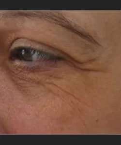 Ultherapy Before & After Patient #327
