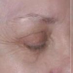 Ultherapy Before & After Patient #330