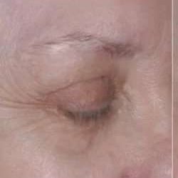 Ultherapy Before & After Patient #330
