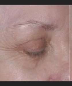 Ultherapy Before & After Patient #330
