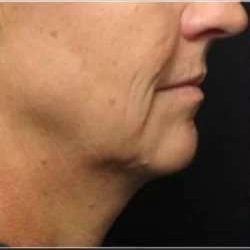 Ultherapy Before & After Patient #333