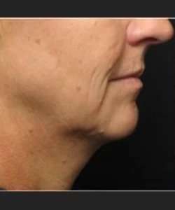 Ultherapy Before & After Patient #333