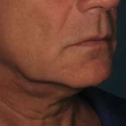 Ultherapy Before & After Patient #336
