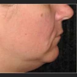 Ultherapy Before & After Patient #339