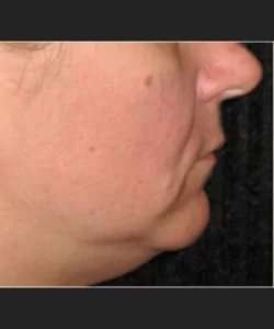Ultherapy Before & After Patient #339