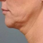 Ultherapy Before & After Patient #342