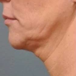 Ultherapy Before & After Patient #342