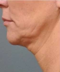Ultherapy Before & After Patient #342