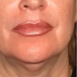Ultherapy Before & After Patient #345