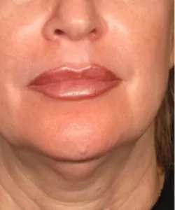 Ultherapy Before & After Patient #345