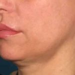 Ultherapy Before & After Patient #348