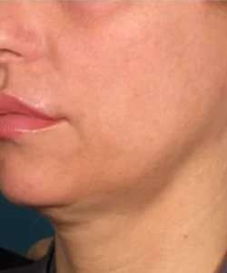 Ultherapy Before & After Patient #348