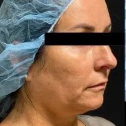 Ultherapy Before & After Patient #351