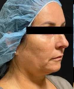 Ultherapy Before & After Patient #351