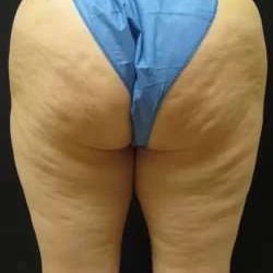 Cellulaze Before & After Patient #362
