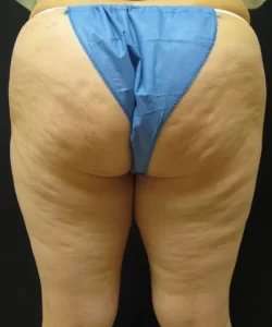 Cellulaze Before & After Patient #362