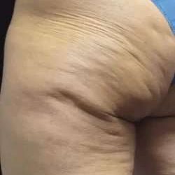 Cellulaze Before & After Patient #365
