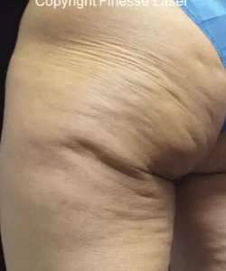 Cellulaze Before & After Patient #365