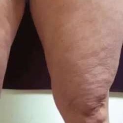 Cellulaze Before & After Patient #368