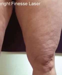 Cellulaze Before & After Patient #368