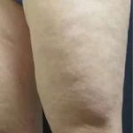 Cellulaze Before & After Patient #374