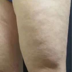 Cellulaze Before & After Patient #374