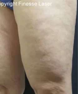 Cellulaze Before & After Patient #374