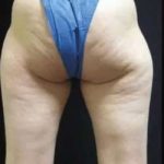 Cellulaze Before & After Patient #377