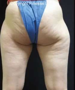 Cellulaze Before & After Patient #377