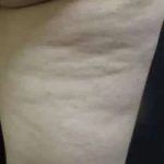 Cellulaze Before & After Patient #380