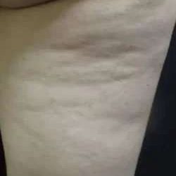 Cellulaze Before & After Patient #380