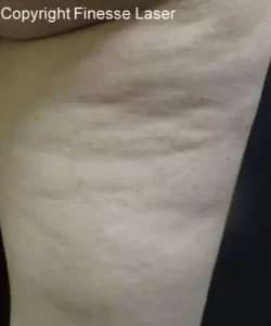 Cellulaze Before & After Patient #380